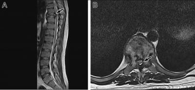 Figure 1: (A) Magnetic resonance imaging (MRI) shows a pathological fracture (arrow) and a lesion in the eighth thoracic vertebral body with loss of the normal marrow fat. (B) MRI shows a heterogeneous lesion involving the body and both pedicles of the eighth thoracic vertebra with narrowed spinal cord canal (arrow). 